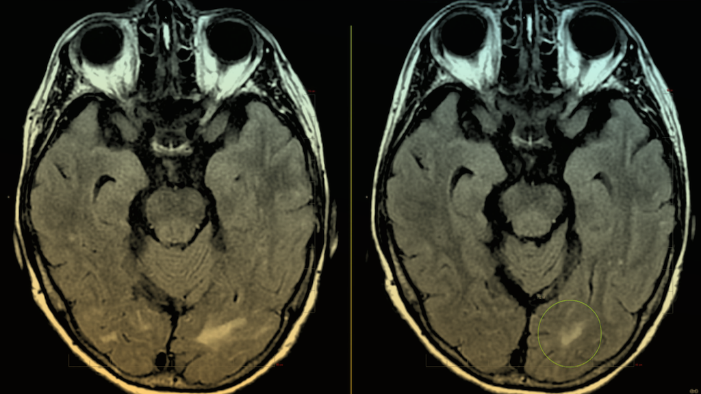 Images of two brain scans with swelling shown in a portion of her brain.