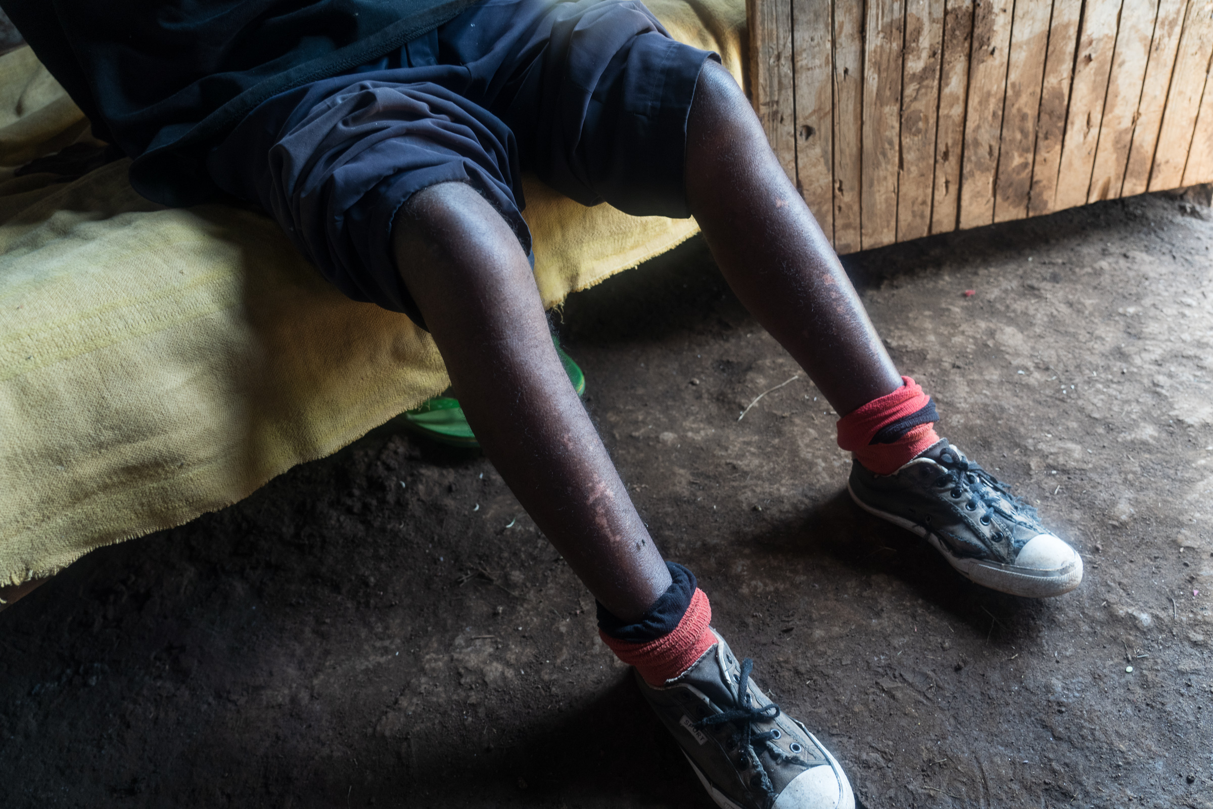 Stephen Muriungi reveals what appear to be chemical burns running down both legs.