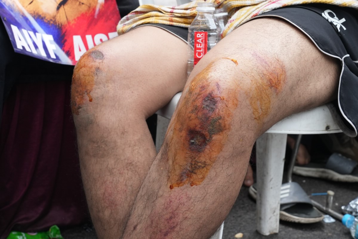 A student protestor displays leg injuries. 